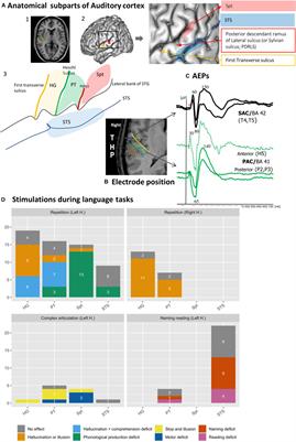 Functional Topography of Auditory Areas Derived From the Combination of Electrophysiological Recordings and Cortical Electrical Stimulation